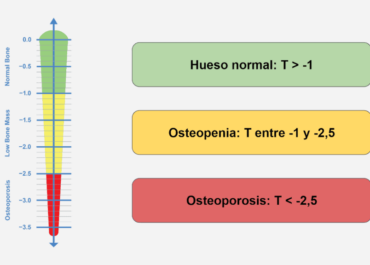 Osteoporosis: qué es, diagnóstico, causas y tratamiento